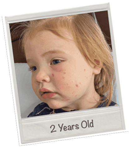 Lila's challenges with atopic dermatitis