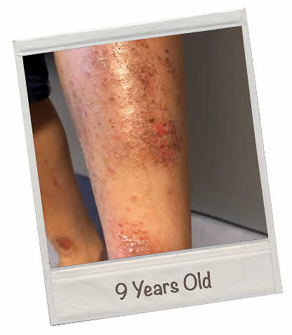 Kayden's challenges with atopic dermatitis